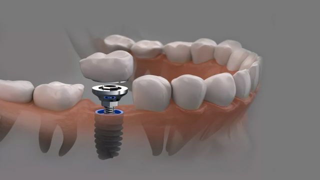 Dental implantta, hastaya en uygun tedavi şeklinin seçilmesi önemli