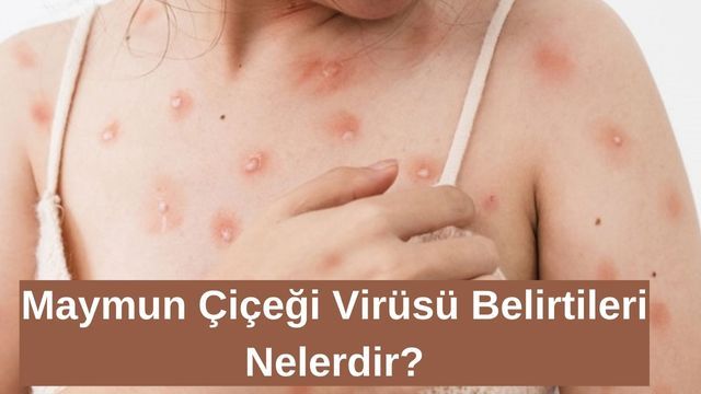 Maymun Çiçeği Virüsü Nedir? Belirtileri Nelerdir?